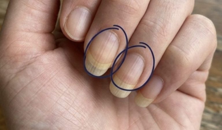 Strukturen auf den Nägeln: Was feine Linien über Ihre Gesundheit verraten