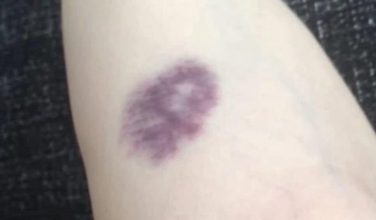 Unerklärliche blaue Flecken: Warnzeichen für ernsthafte Gesundheitsprobleme erkennen