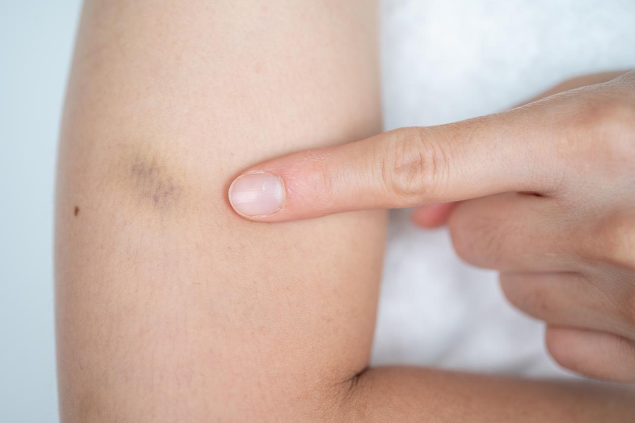 Nahaufnahme eines blauen Flecks auf der Haut